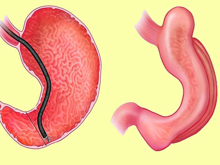 Entenda como funciona a Gastroplastia endoscópica