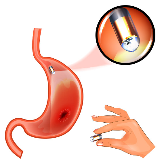 Entenda como funciona a Cápsula endoscópica