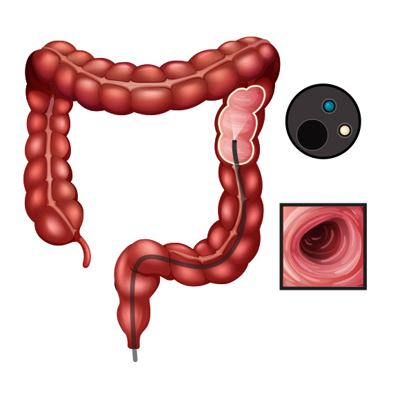 Entenda como funciona a Colonoscopia