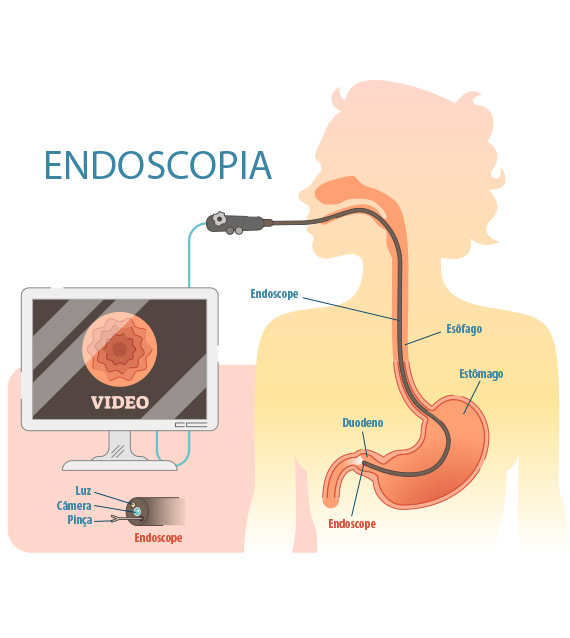 Entenda como funciona Endoscopia Digestiva Alta