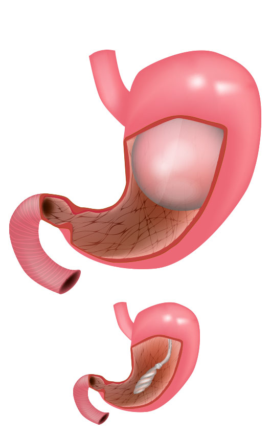 Entenda como funciona o Balão intragástrico